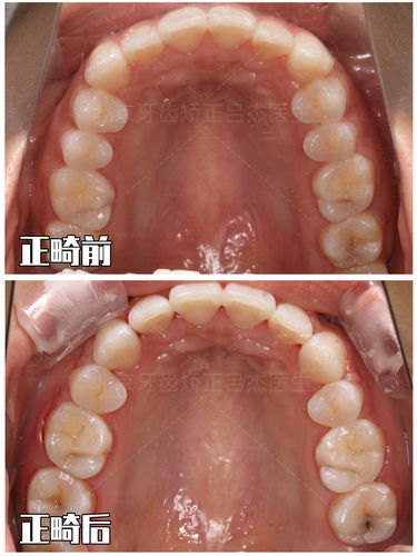上牙槽骨突出正畸-图1