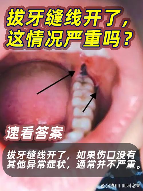 正畸拔牙疼到怀疑人生？到底是什么原因这么痛苦？-图3