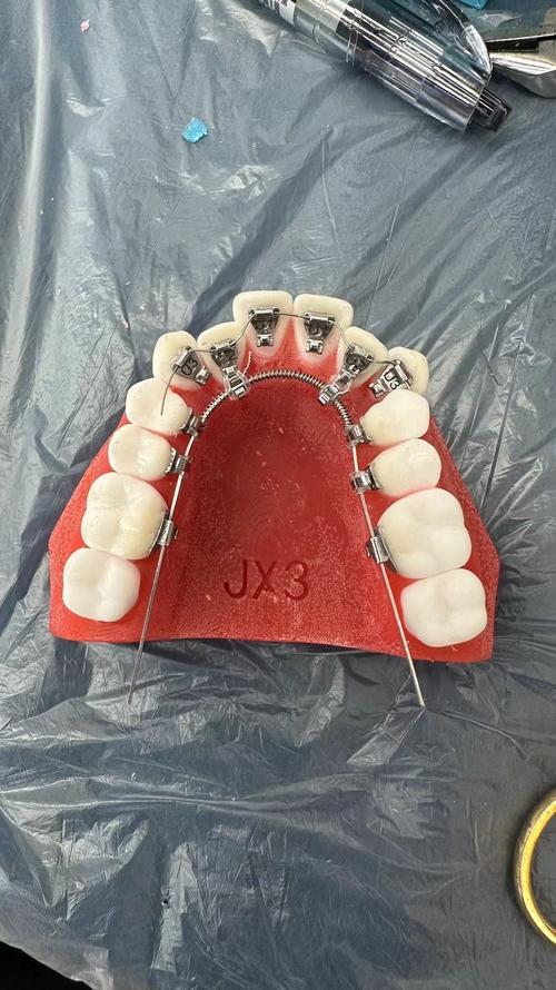 正畸靠切端贴托槽-图3