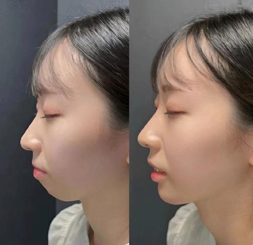 正畸改变下巴后缩-图2