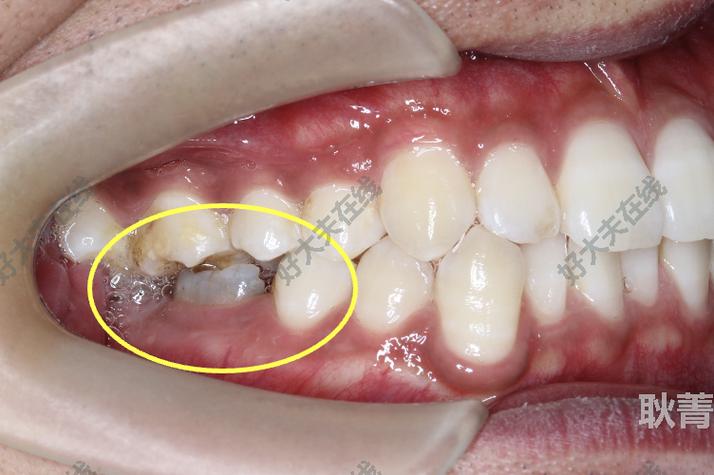 正畸关闭门牙间隙-图1