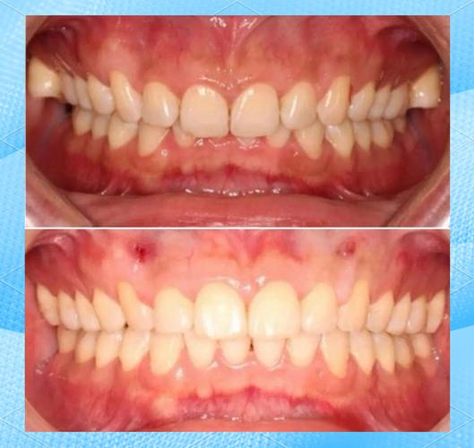 正畸后导致深覆合-图2