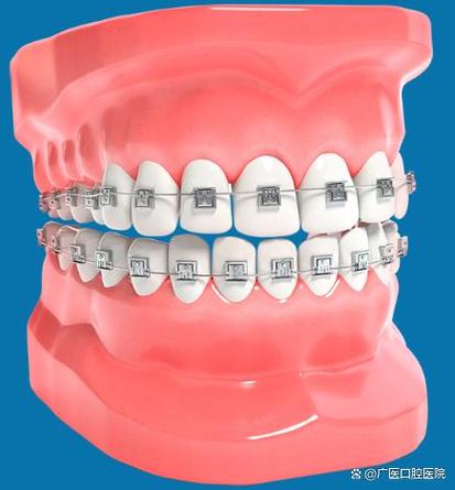 半口陶瓷正畸价格大概多少?包含哪些项目?-图3 半口陶瓷正畸价格大概多少?包含哪些项目?-图3