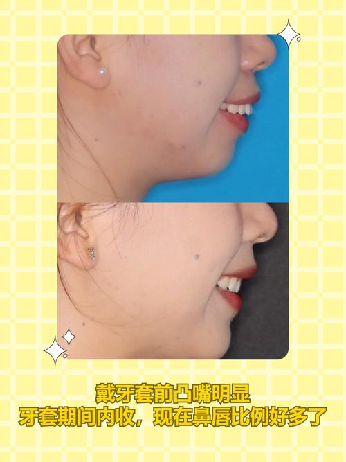 美容冠矫正和正畸有何区别?如何根据需求选择?-图1 美容冠矫正和正畸有何区别?如何根据需求选择?-图1