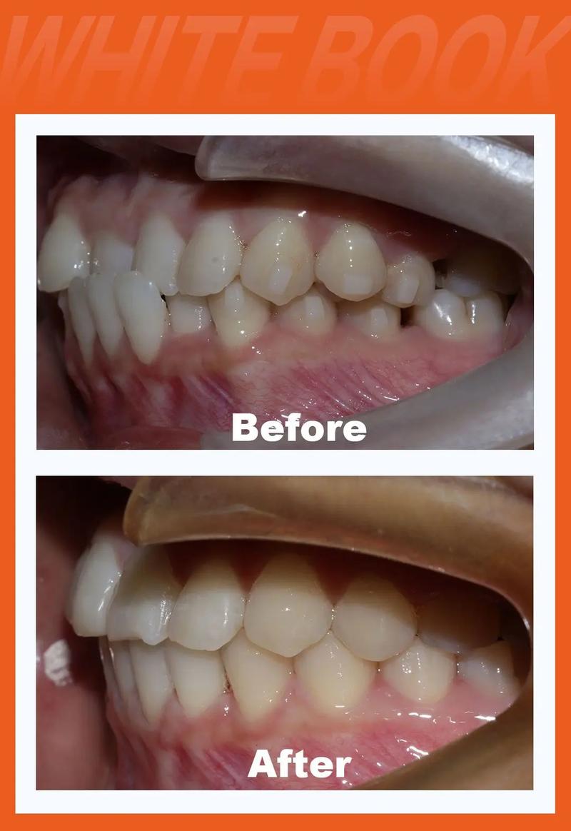 美容冠矫正和正畸有何区别?如何根据需求选择?-图2 美容冠矫正和正畸有何区别?如何根据需求选择?-图2