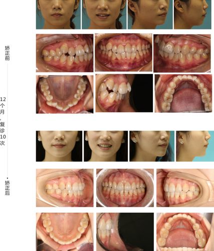 口腔正畸模特征集有何核心特征及临床应用价值？-图3