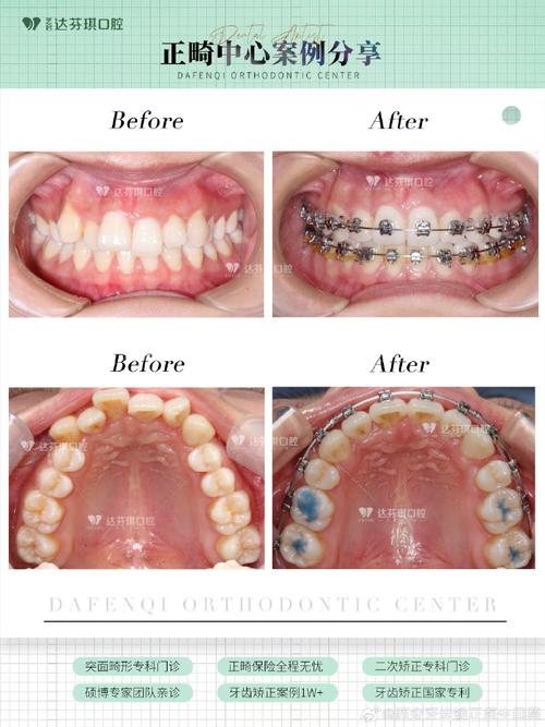 不想正颌手术正畸，不手术矫正可行吗？-图1