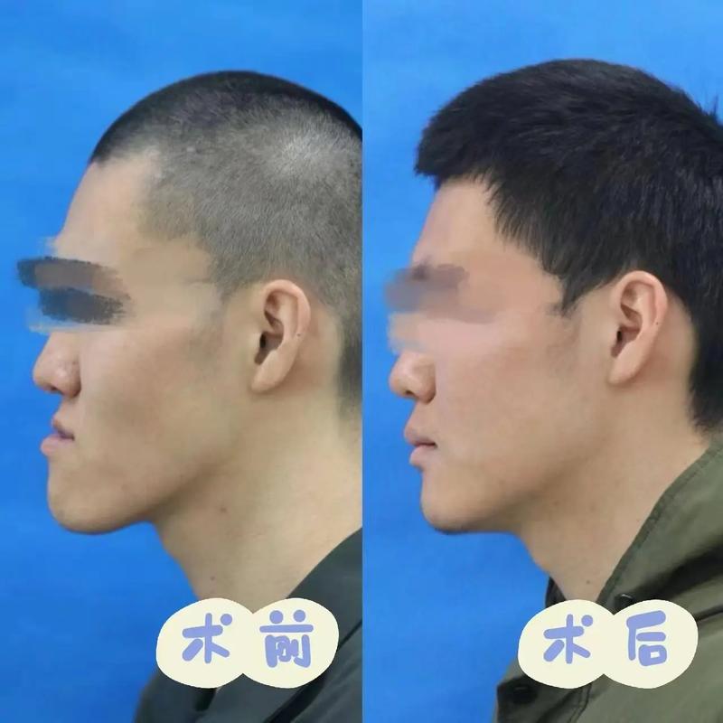 不想正颌手术正畸，不手术矫正可行吗？-图2