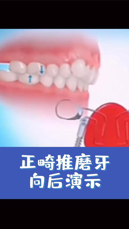 磨牙后推正畸过程是怎样的？步骤和效果如何？-图1