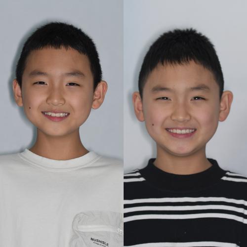 正畸中如何根据面部生长型制定干预策略？-图1