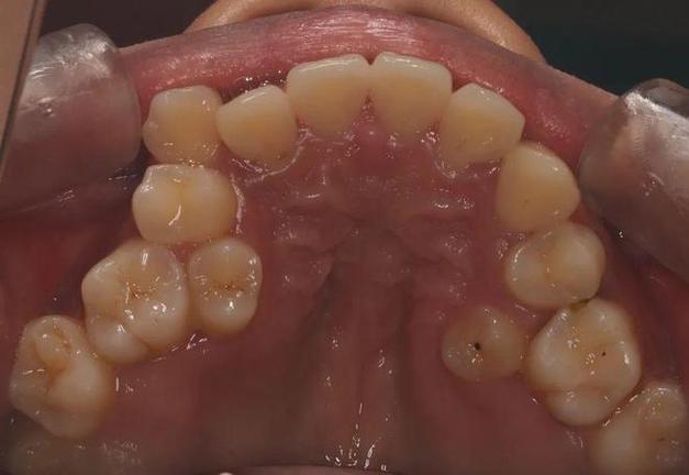 正畸前磨牙无接触，是何原因？有何影响？如何处理？-图2