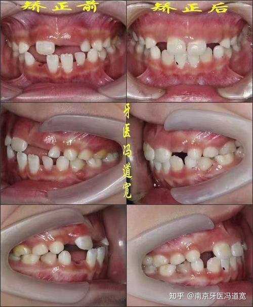 正畸前磨牙无接触，是何原因？有何影响？如何处理？-图3