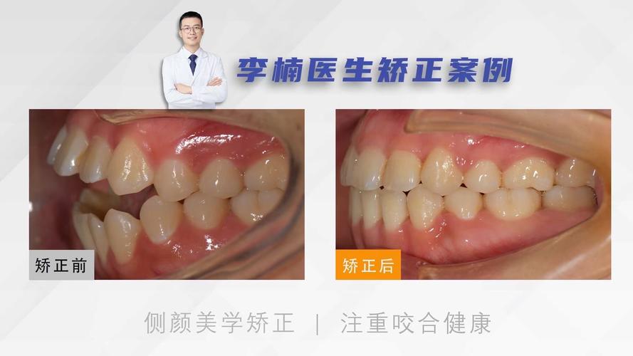 口腔正畸开合，矫正视频能解答哪些疑问？-图3