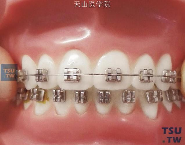 正畸方丝中点标记,如何精准定位?临床价值体现在哪?-图1 正畸方丝中点标记,如何精准定位?临床价值体现在哪?-图1