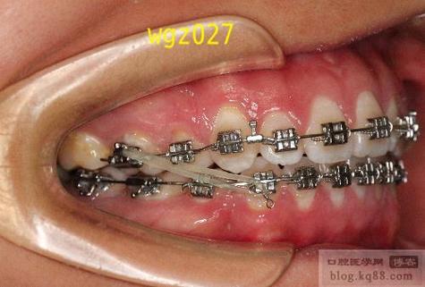 正畸方丝中点标记，如何精准定位？临床价值体现在哪？-图3