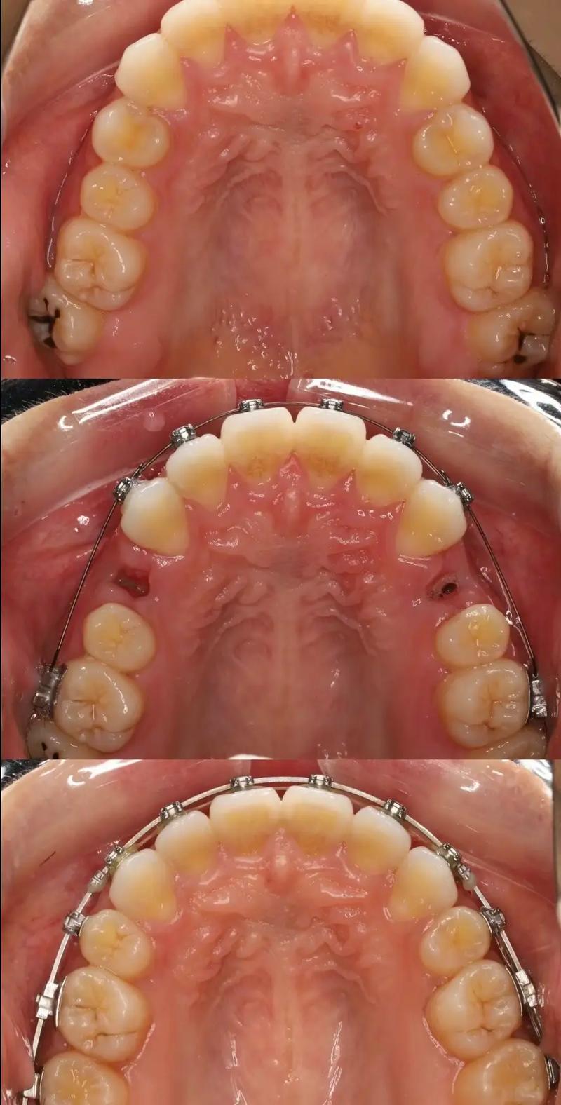正畸片段弓是什么？它的原理、作用及适用范围具体是怎样的？-图3