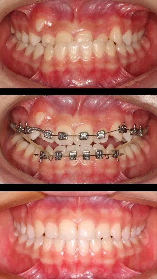 正畸片段弓是什么？它的原理、作用及适用范围具体是怎样的？-图1