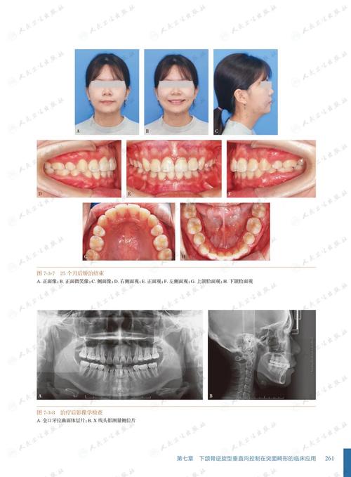 正畸骨性畸形分类的临床意义与标准是什么?-图3 正畸骨性畸形分类的临床意义与标准是什么?-图3