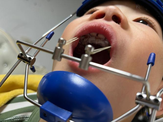 正畸早期轻力牵引有何独特矫正优势？-图3