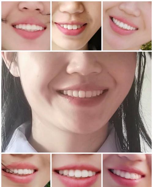 牙齿正畸之后的图-图3