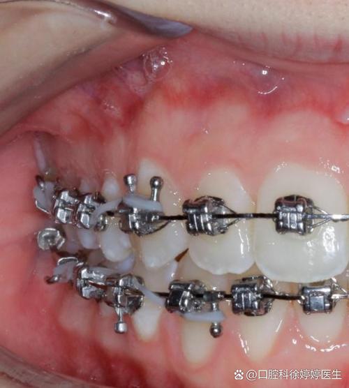 牙齿正畸去哪家好？靠谱机构怎么选？-图1