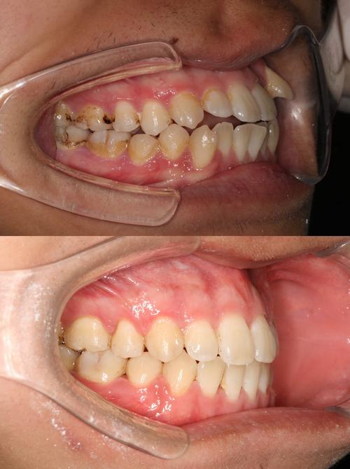 正畸j钩危害照片真实吗？是否反映实际风险？-图1