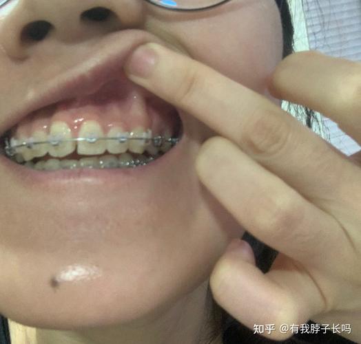 正畸j钩危害照片真实吗？是否反映实际风险？-图3