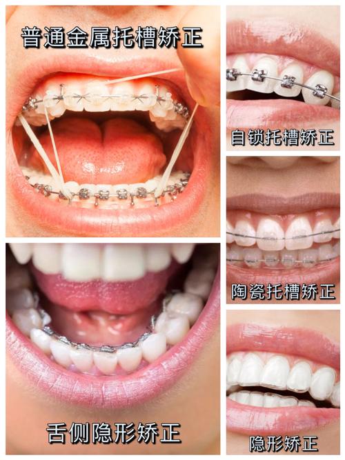 牙齿正畸选什么牙套？不同类型优缺点及适用人群有哪些？-图1