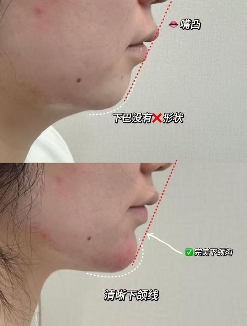 正畸下颌矫正中有哪些常用类型的线？-图1