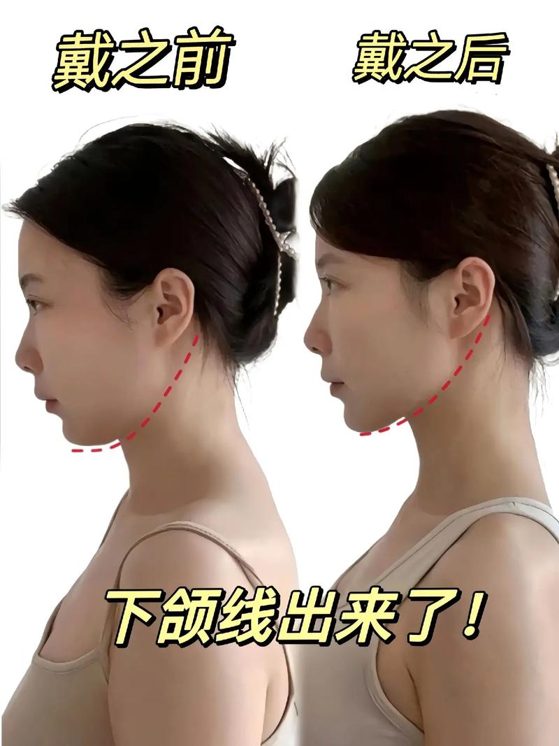 正畸下颌矫正中有哪些常用类型的线？-图3