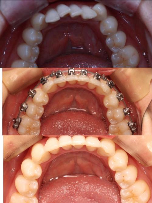 正畸托槽粘结过程的关键步骤和注意事项有哪些？-图2