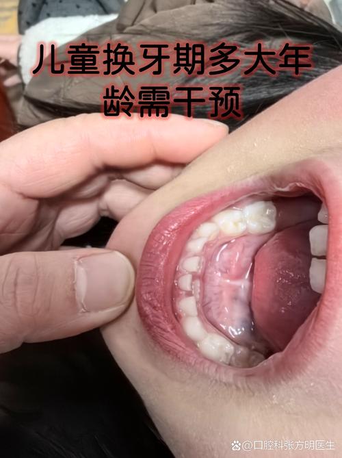 换牙期间进行牙齿正畸是否合适？-图1