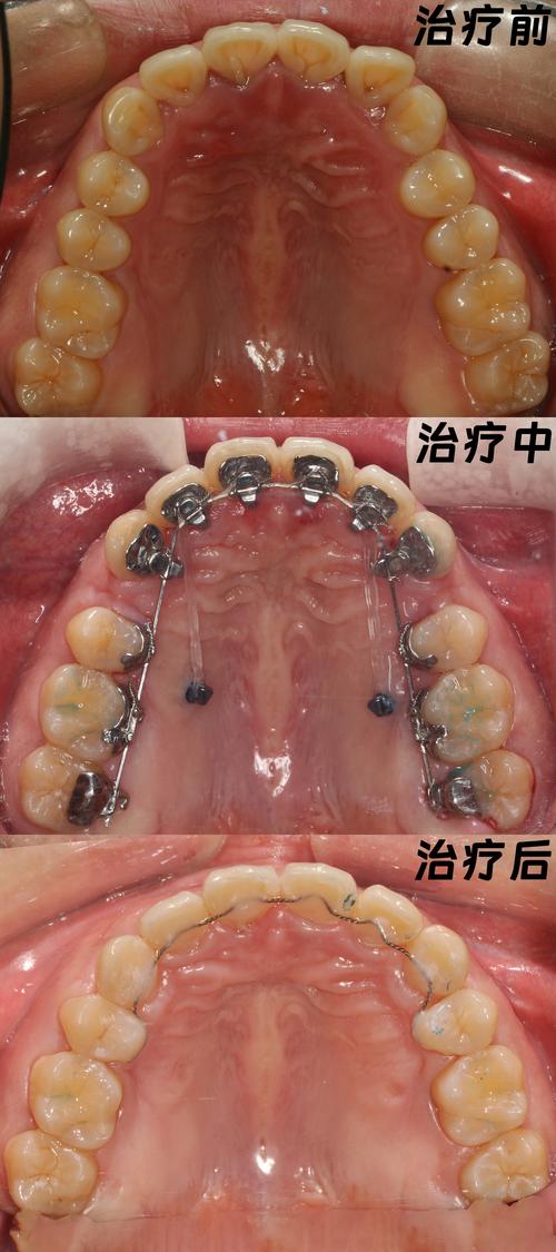 杭州舌侧正畸牙医技术如何？效果好不好？怎么选？-图2