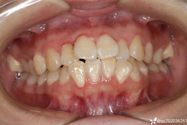 正畸高低角的拔牙-图1