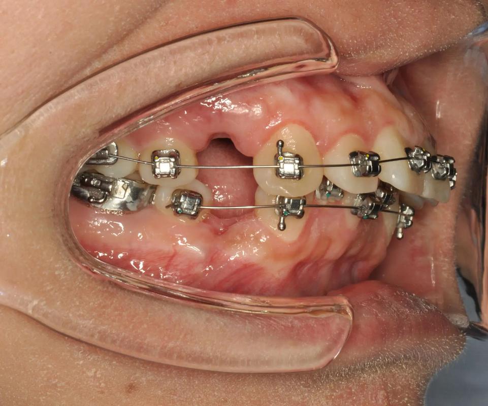 正畸带环怎么粘？粘贴步骤及注意事项详解-图3