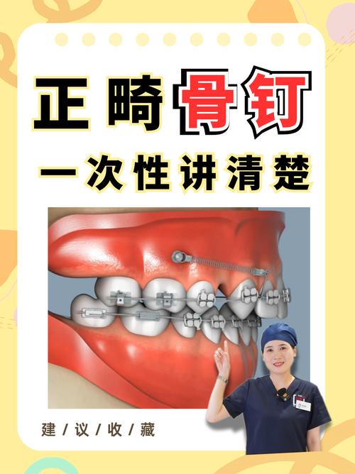 种植钉正畸官网能查到哪些关键信息？-图1