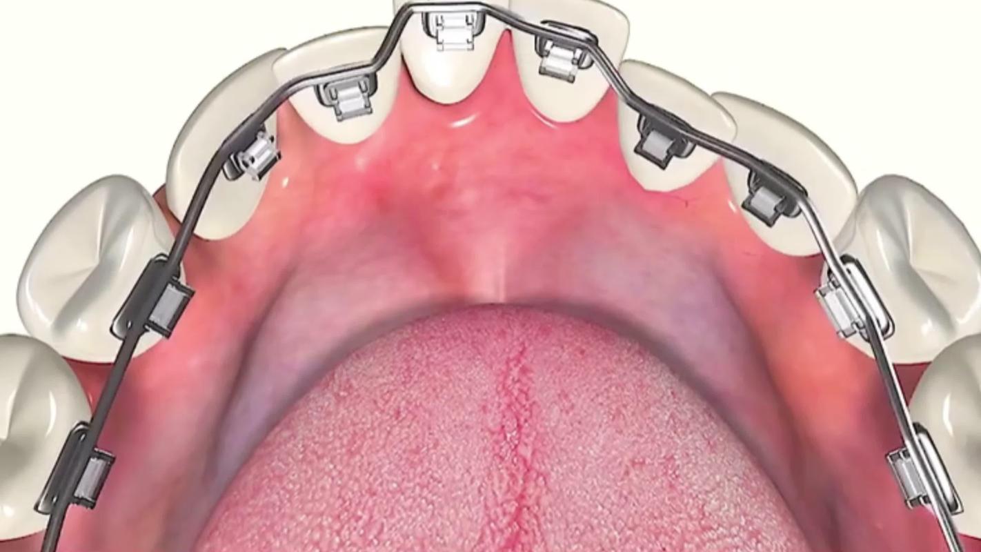 正畸舌簧加力部位-图3