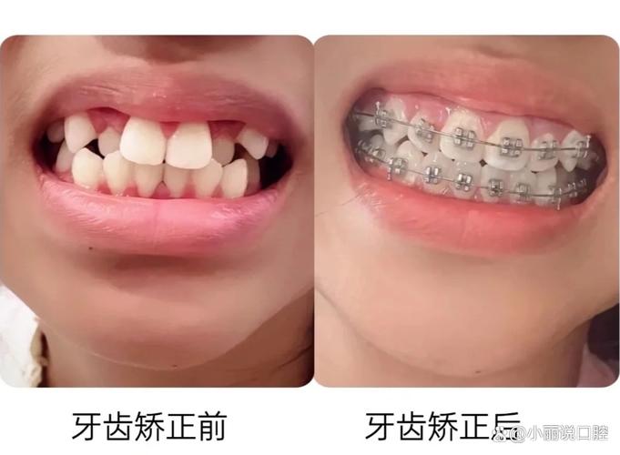 牙齿不齐矫正疼吗?正畸过程会有多痛苦?-图1 牙齿不齐矫正疼吗?正畸过程会有多痛苦?-图1