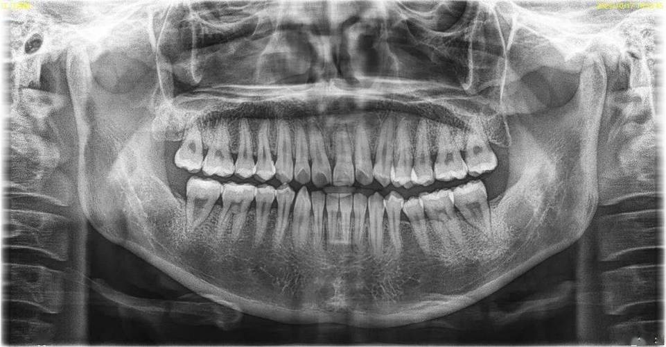 正畸减数牙拍全景片，到底能解决哪些关键问题？-图1