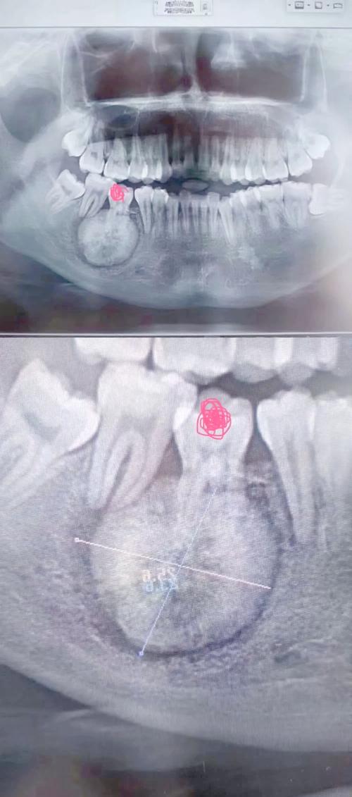 正畸减数牙拍全景片，到底能解决哪些关键问题？-图3