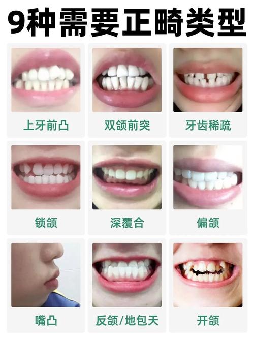 正畸牙齿前牙关系-图3
