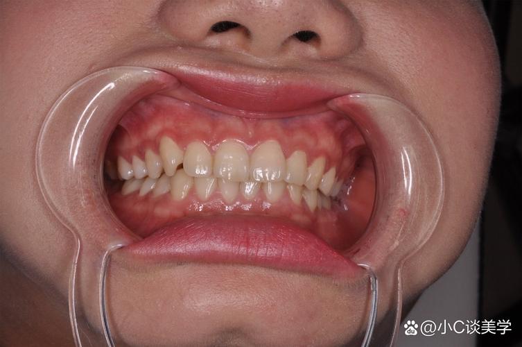 正畸后牙齿往外斜?原因分析与应对方法-图2 正畸后牙齿往外斜?原因分析与应对方法-图2