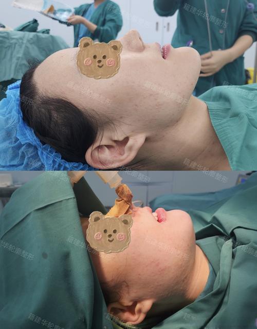 反下颌骨正畸手术能彻底解决地包天问题吗？-图3