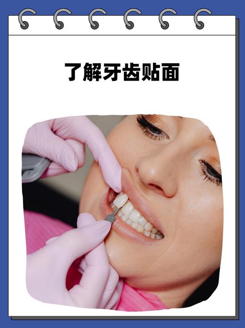 牙贴面能做正畸吗-图3 牙贴面能做正畸吗-图3