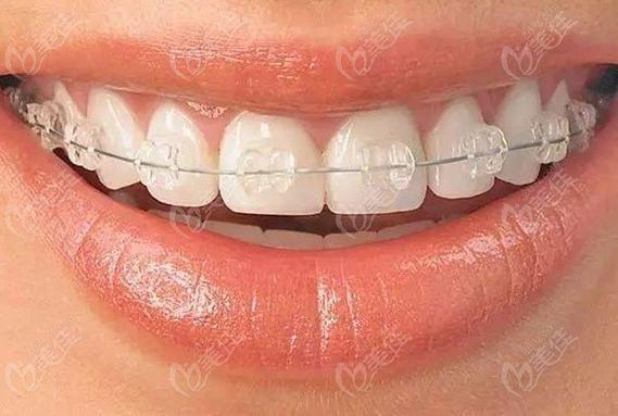 正畸陶瓷自锁矫正相比传统矫正有哪些优势？-图1