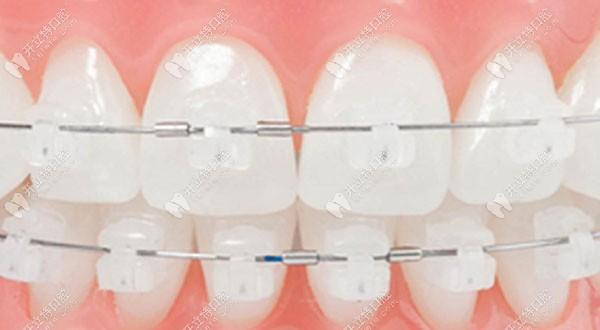正畸陶瓷自锁矫正相比传统矫正有哪些优势？-图2