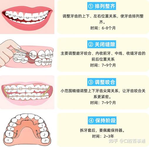 正畸牙套怎么调整-图1