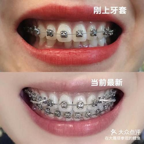 自锁牙正畸视频能看懂哪些矫正关键细节?-图2 自锁牙正畸视频能看懂哪些矫正关键细节?-图2