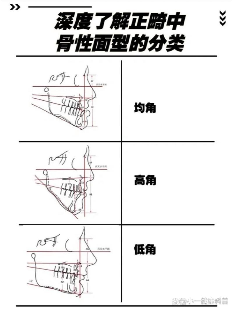 正畸面型角的定义究竟指什么？-图3