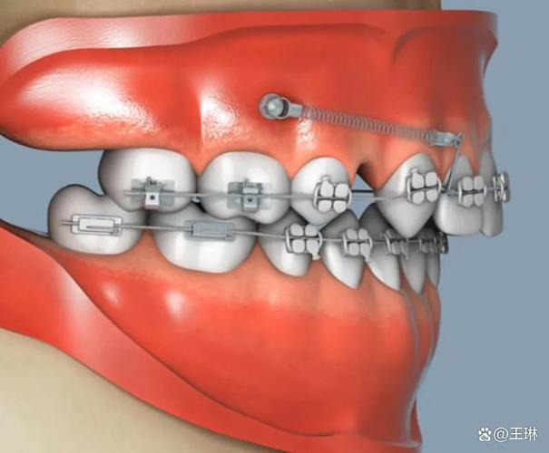 正畸下颌内收支抗如何有效控制?-图1 正畸下颌内收支抗如何有效控制?-图1